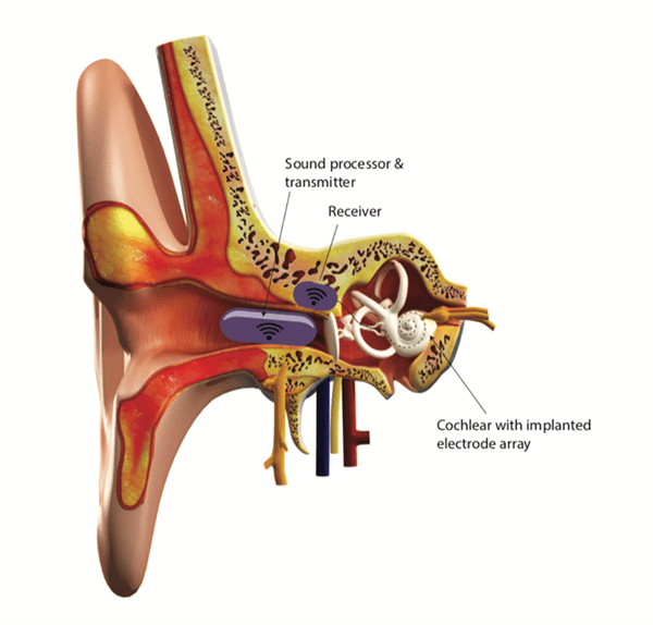 Diagram showing set up of implant. Showing Sound processor and transmitter in ear canal, receiver embed in bone, and the cochlear with implanted electrode array. Diagram showing set up of implant. Showing Sound processor and transmitter in ear canal, receiver embed in bone, and the cochlear with implanted electrode array.