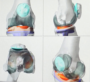 Computer rendered images of a knee. The images are translucent allowing specific areas of focus to be coloured.