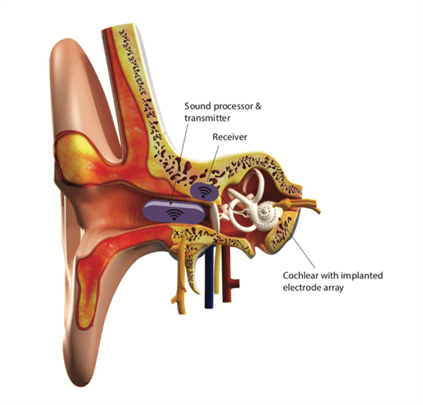 Diagram showing set up of implant. Showing Sound processor and transmitter in ear canal, receiver embed in bone, and the cochlear with implanted electrode array.