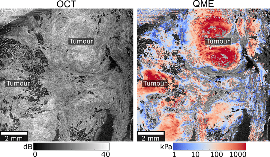 Two images of a tumour. Image on the left is showing Optical Coherence Tomography and the image on the right is displaying Quantitative Micro-Elastography.